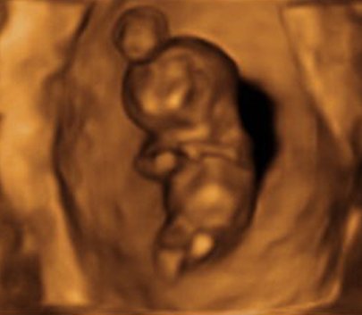 Baby im Ultraschall